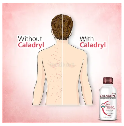 caladryl lotion 125 ml